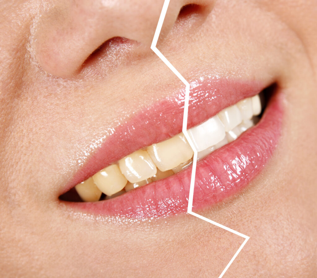 Teeth Whitening - PHC Dental Care of Miami Florida