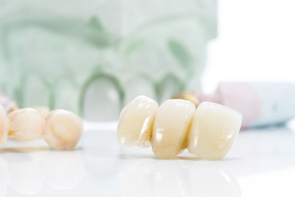 Crowns and Caps - PHC Dental Care of Miami Florida