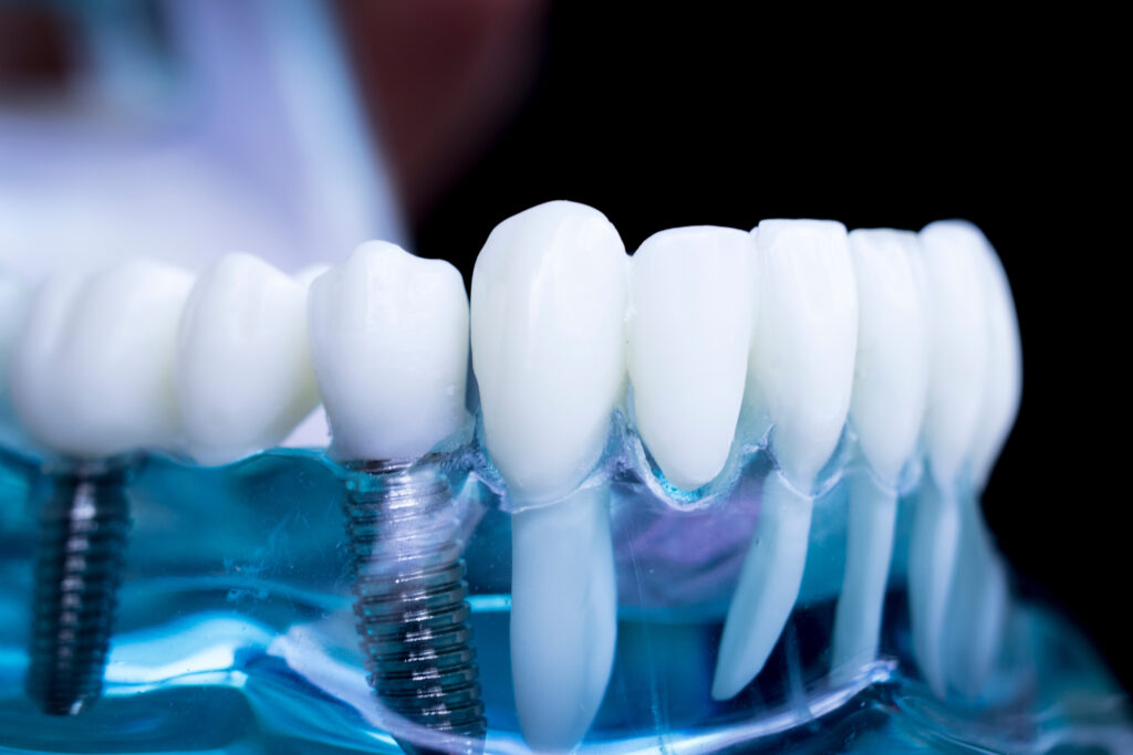 Implant Supported Bridges - PHC Dental Care of Miami Florida