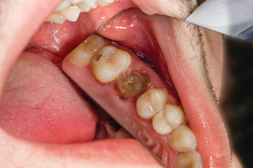 Sensitive Teeth- PHC Dental Care of Miami Florida