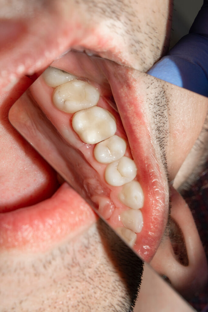 Gum Disease Treatment- PHC Dental Care of Miami Florida