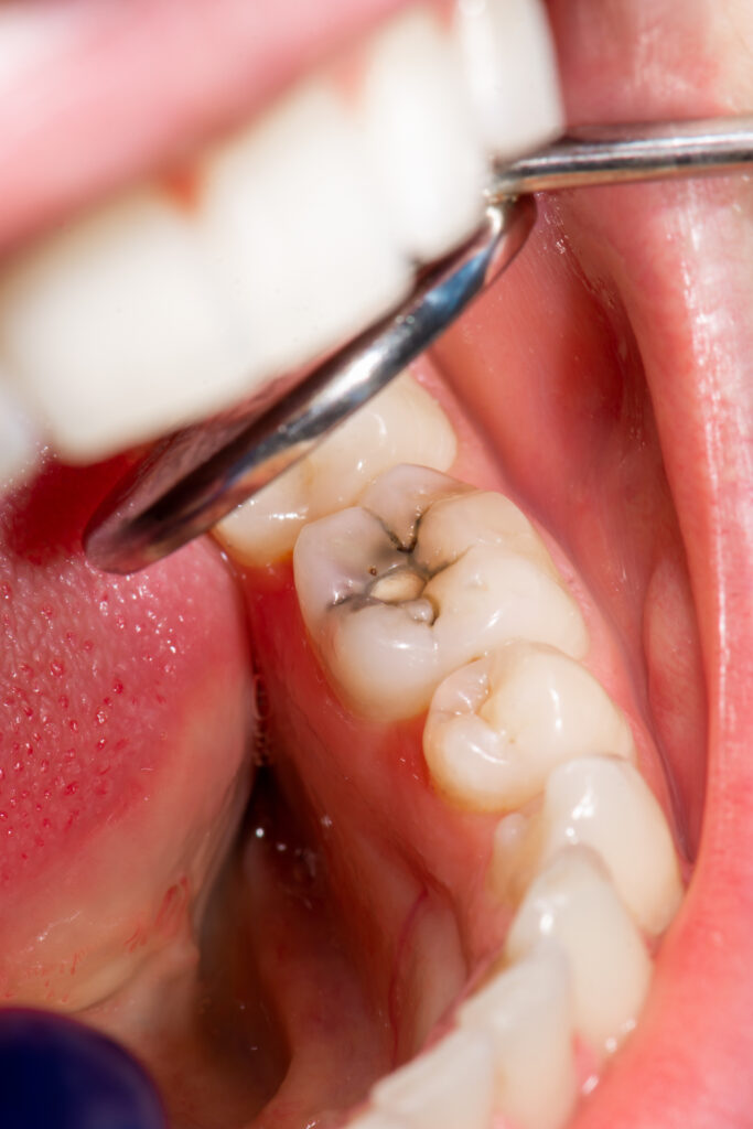 Root Infection- PHC Dental Care of Miami Florida