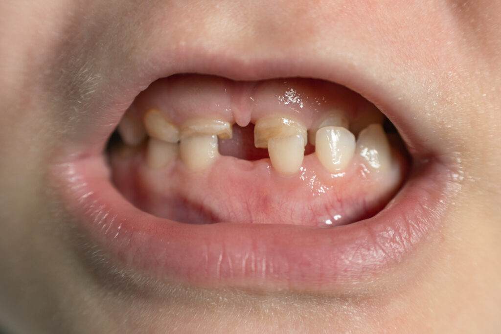 Teeth Grinding - PHC Dental Care of Miami Florida