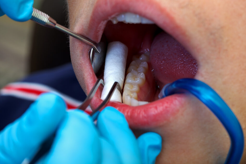 Regular Teeth Cleanings - PHC Dental Care of Miami Florida